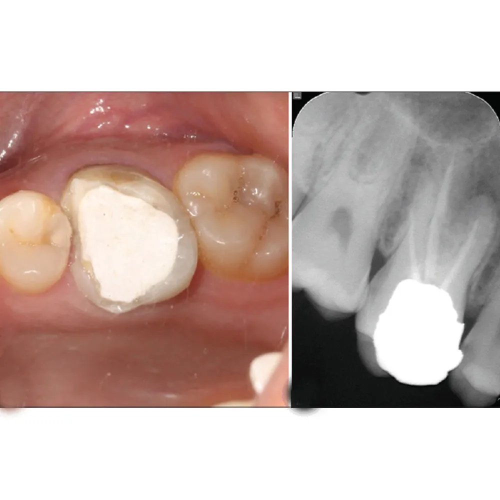 thumbnail image 2 of Ammdent Cavitemp Self-Curing Temporary Filling Cement For Dental Use 2 of 5
