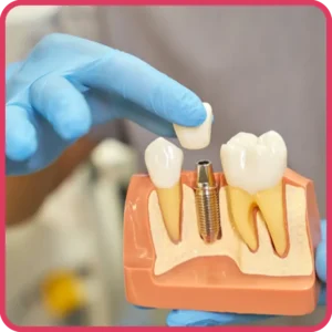 Implantology - Alpha Dentkart