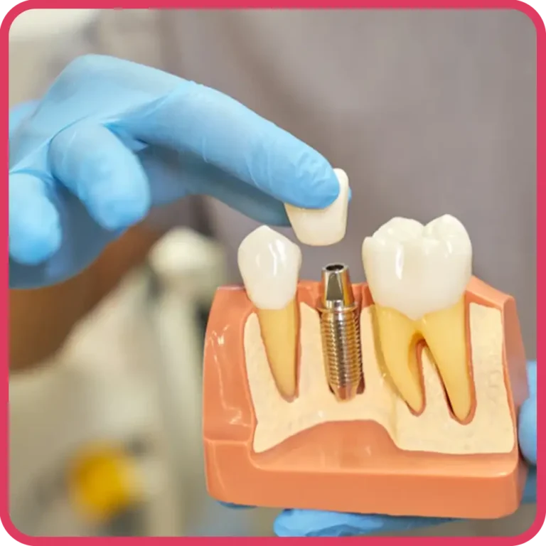 Implantology - Alpha Dentkart